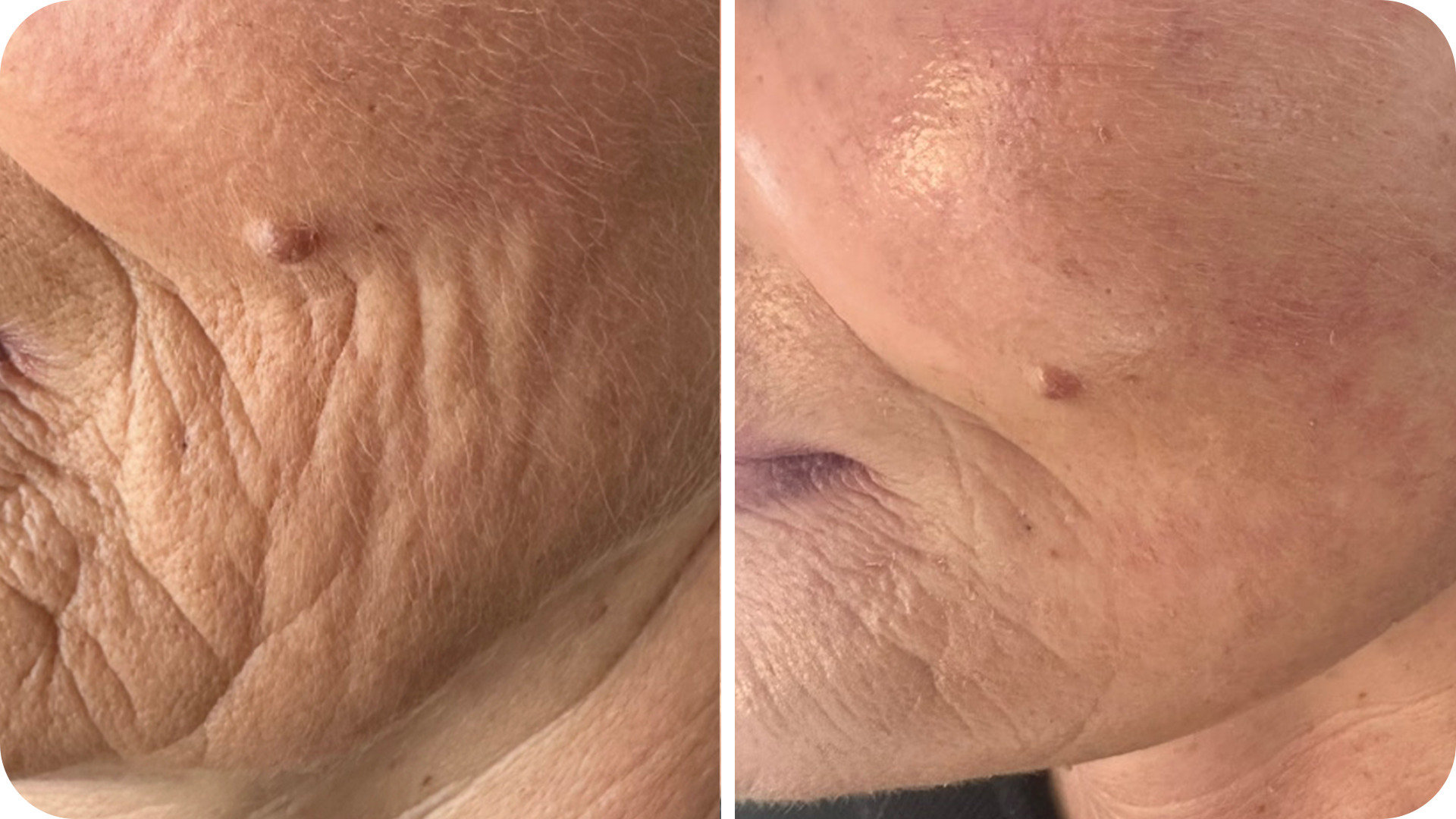 futuracontour_beforeandafter