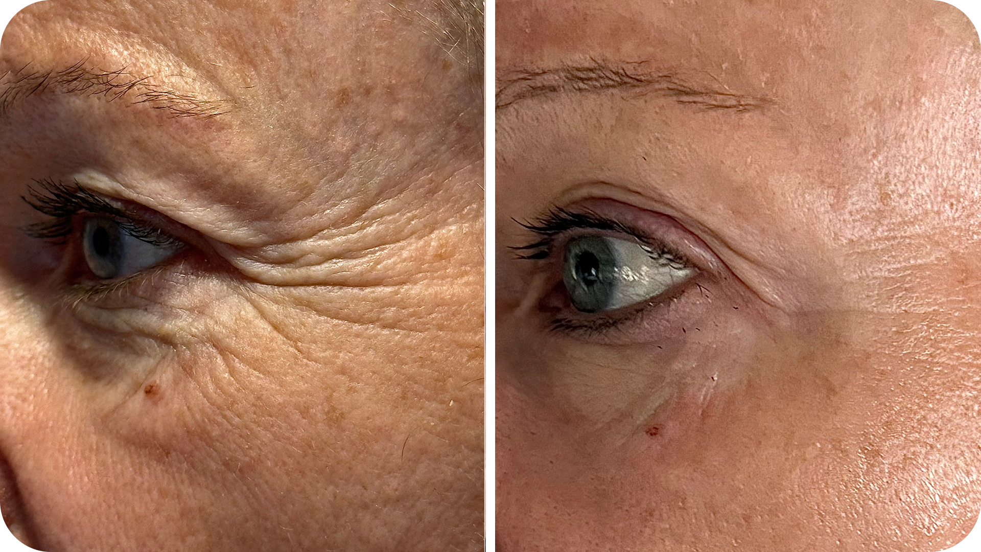 futuracontour_beforeandafter