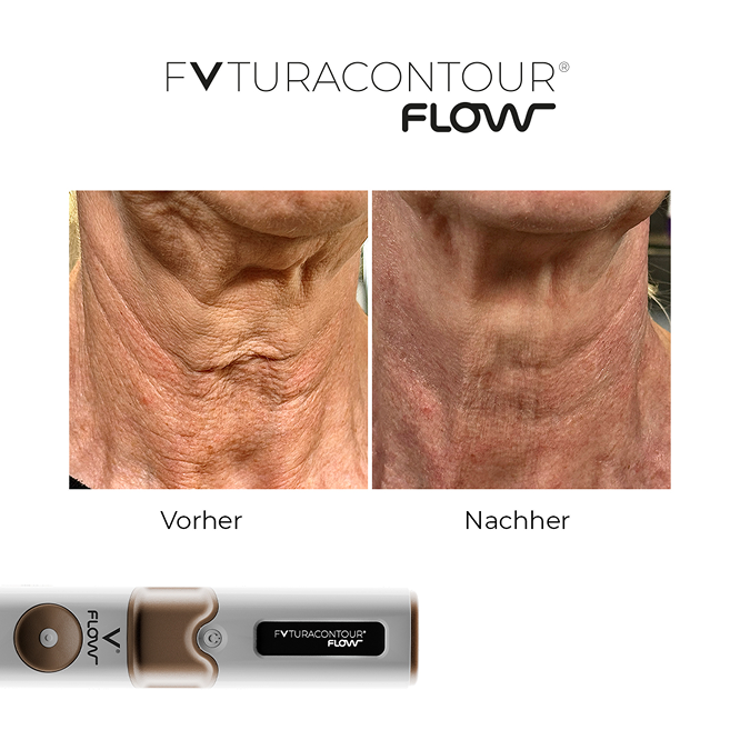futuracontour_beforeandafter