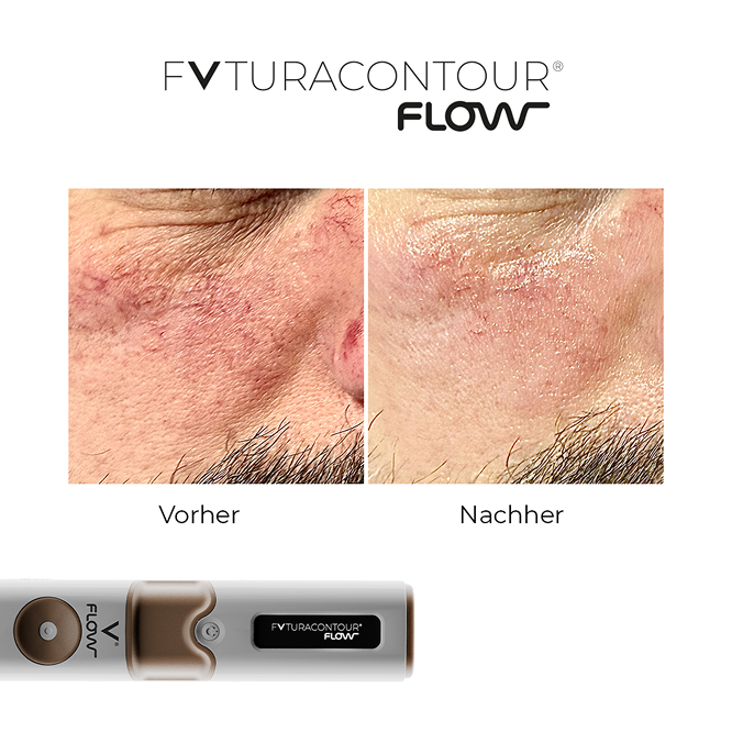futuracontour_beforeandafter