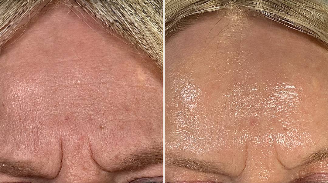 futuracontour_beforeandafter