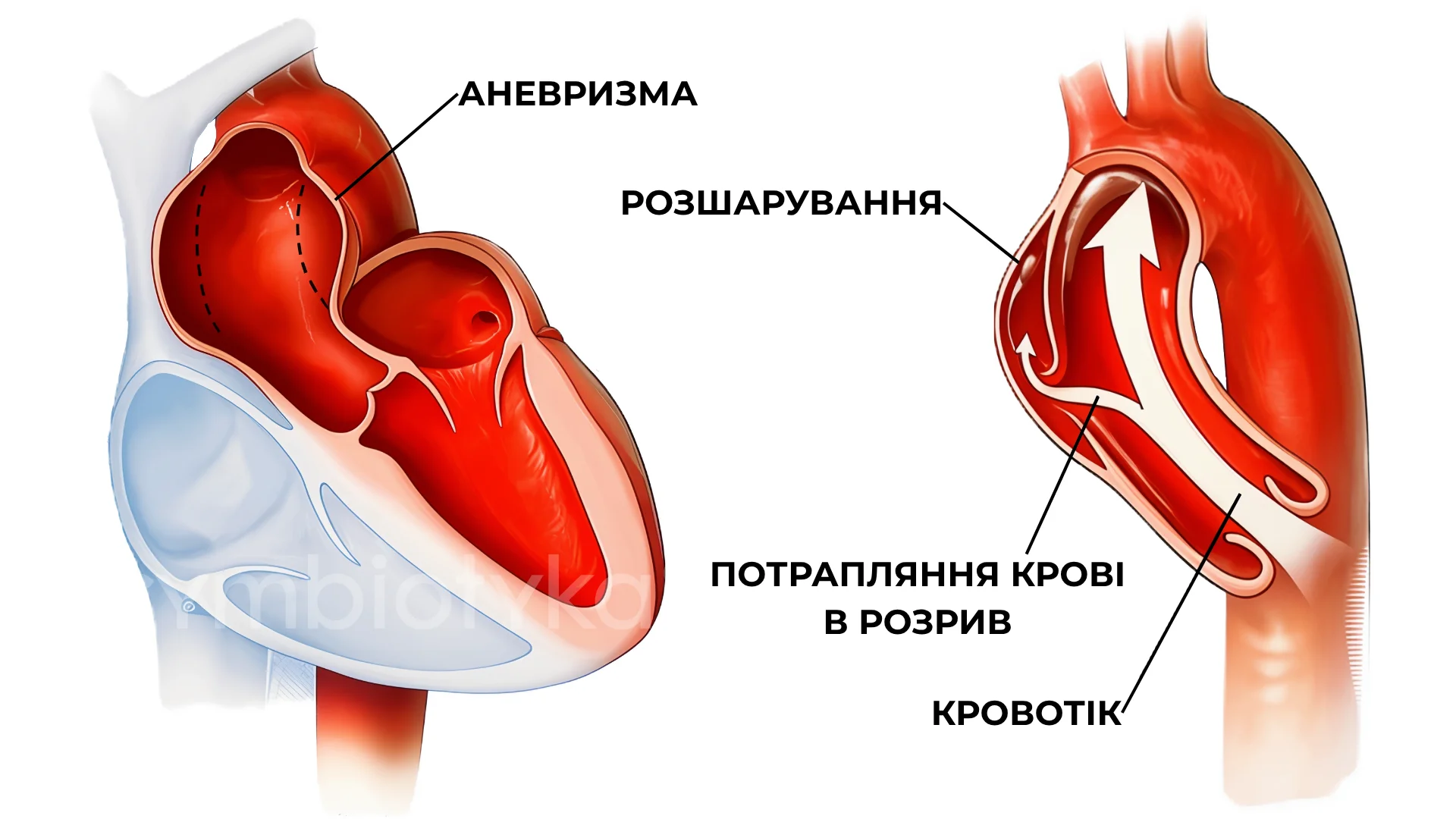 Розшарування аорти (дисекція)