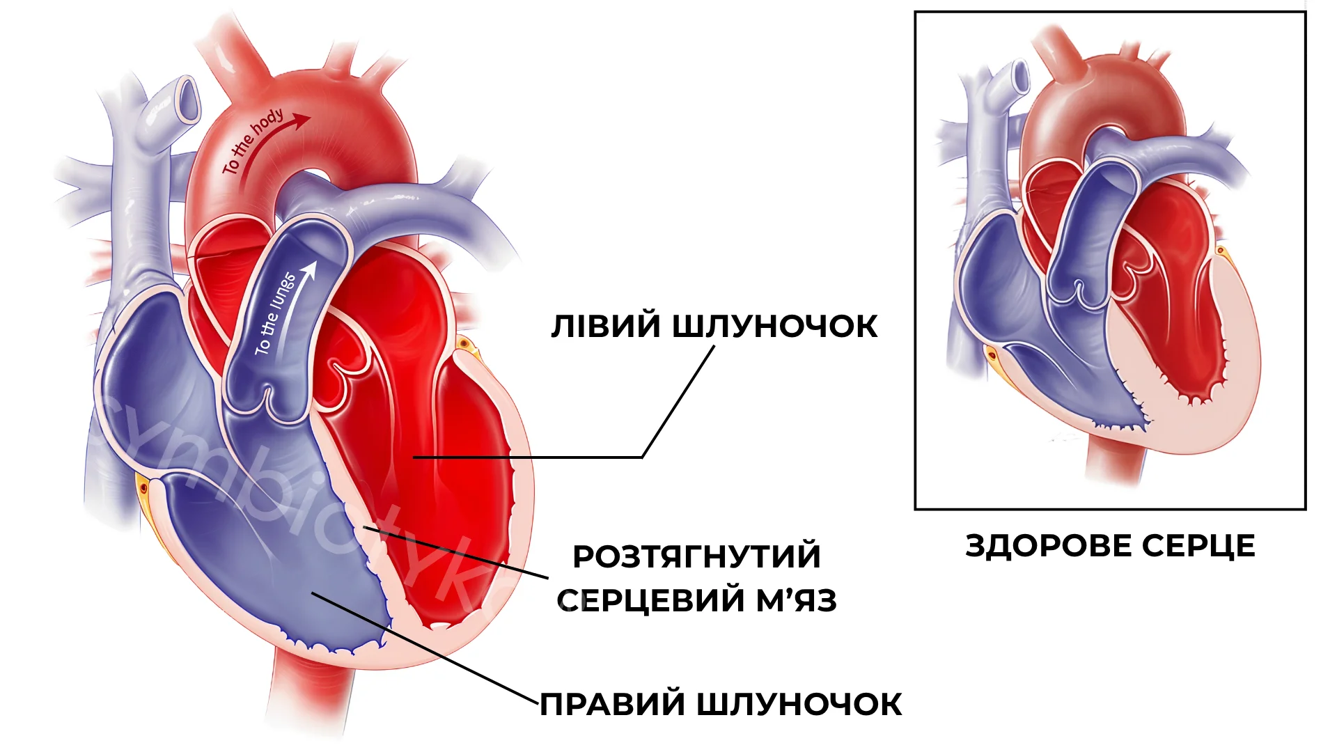 Алкогольна та Токсична Кардіоміопатія