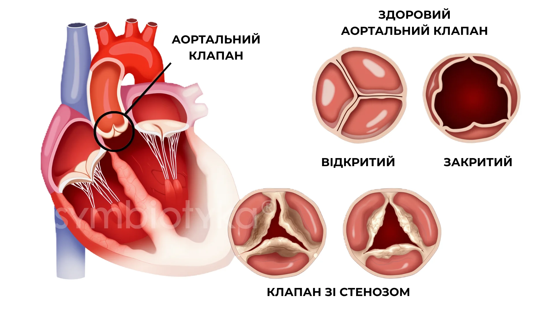 Аортальний стеноз