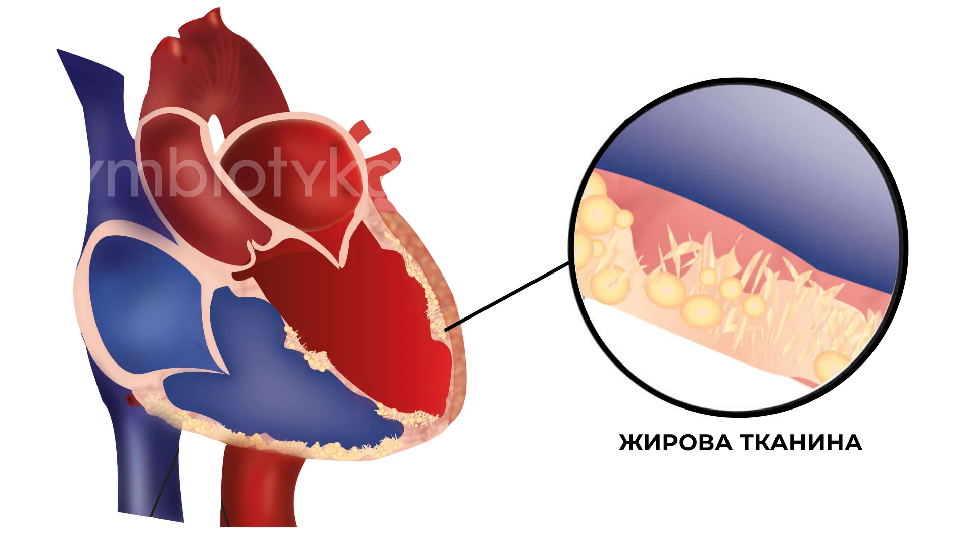 Аритмогенна кардіоміопатія правого шлуночка (АКПШ)