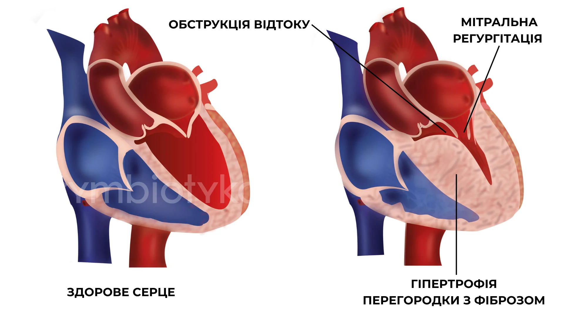 Гіпертрофічна кардіоміопатія (ГКМП)