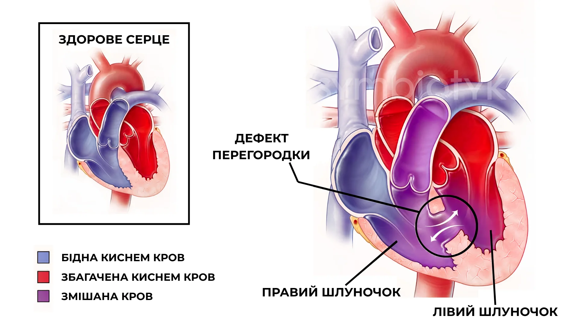 Дефект міжшлуночкової перегородки (ДМШП)