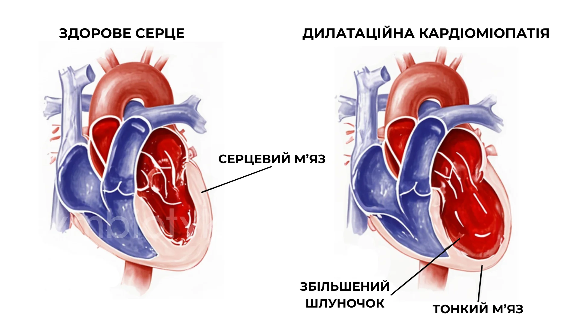 Дилатаційна кардіоміопатія (ДКМП)