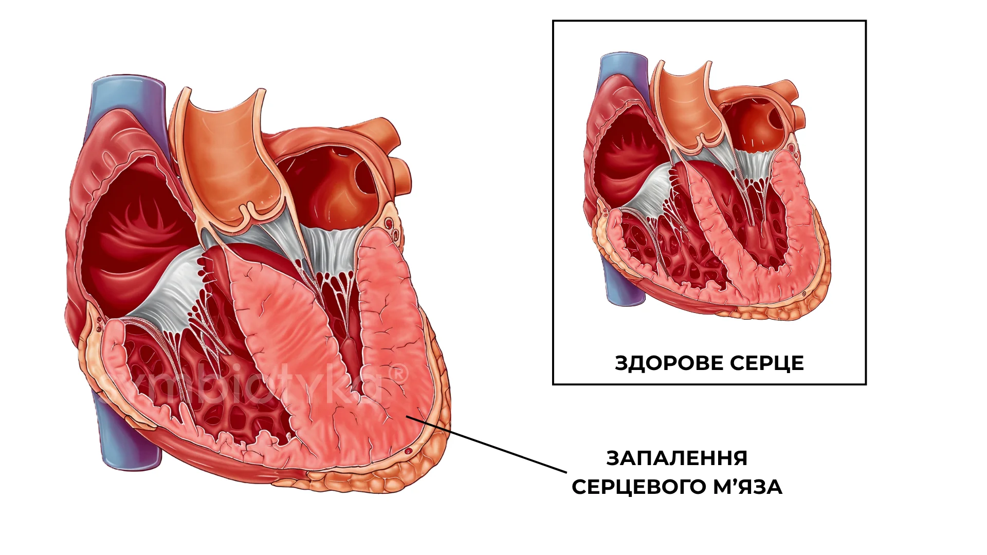 Міокардит