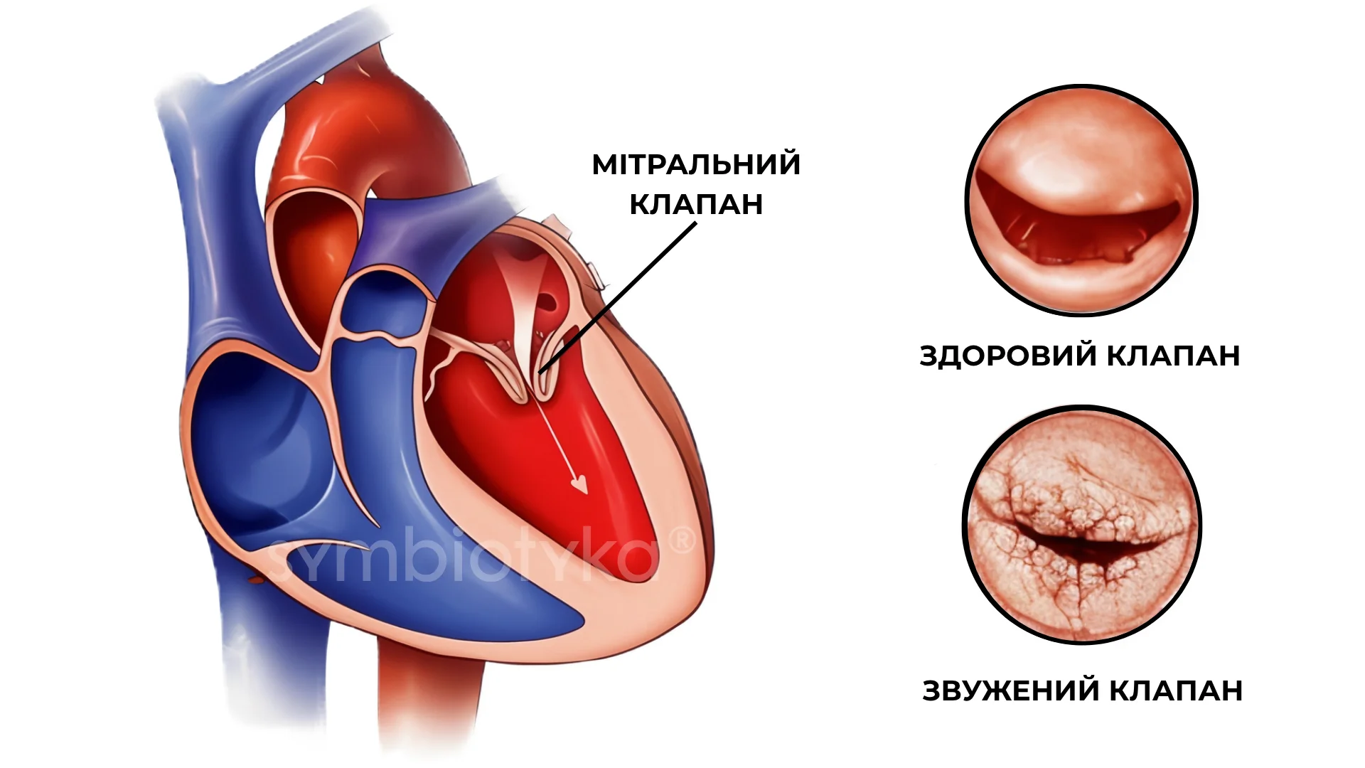 Мітральний стеноз