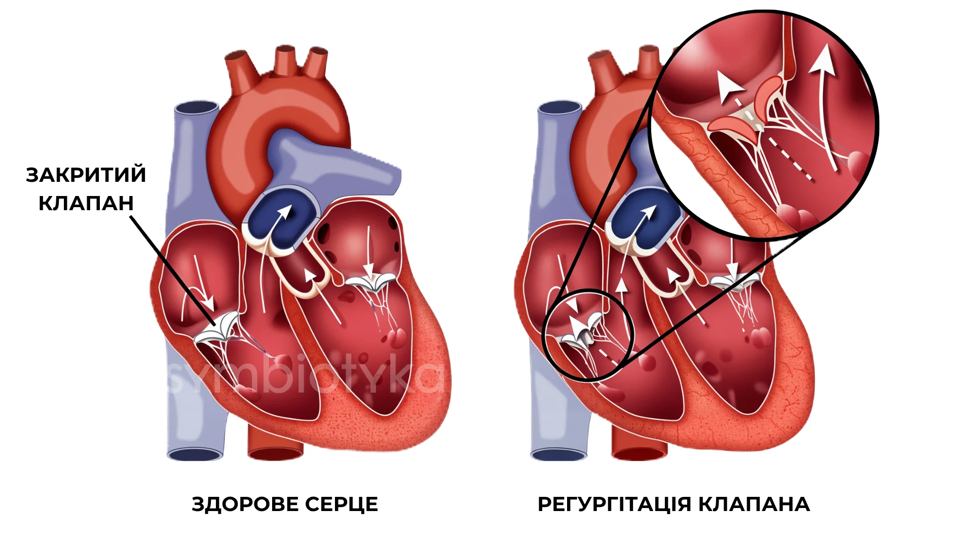 Недостатність клапанів серця (регургітація)