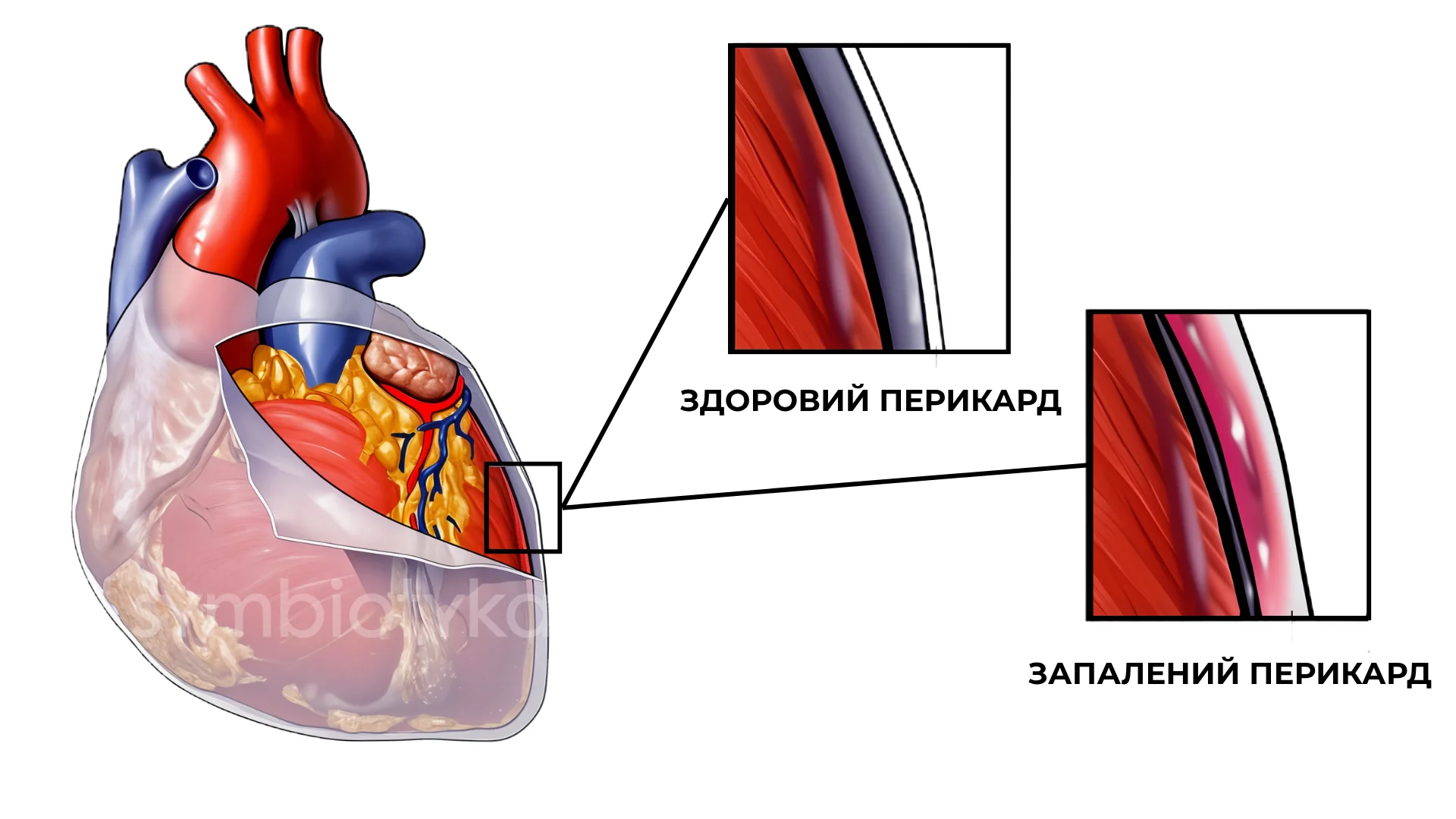 Перикардит