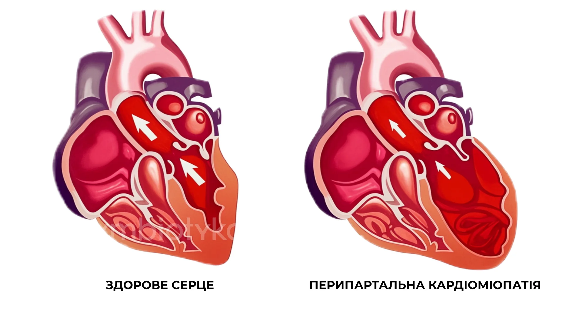 Перипартальна кардіоміопатія