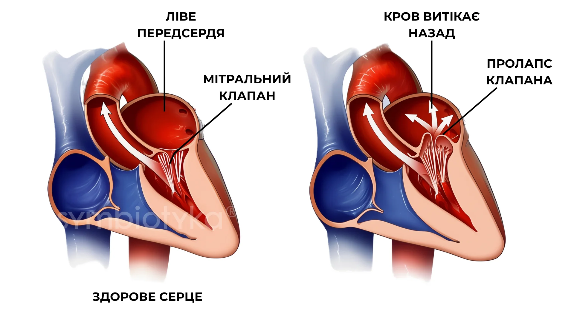 Пролапс мітрального клапана (ПМК)