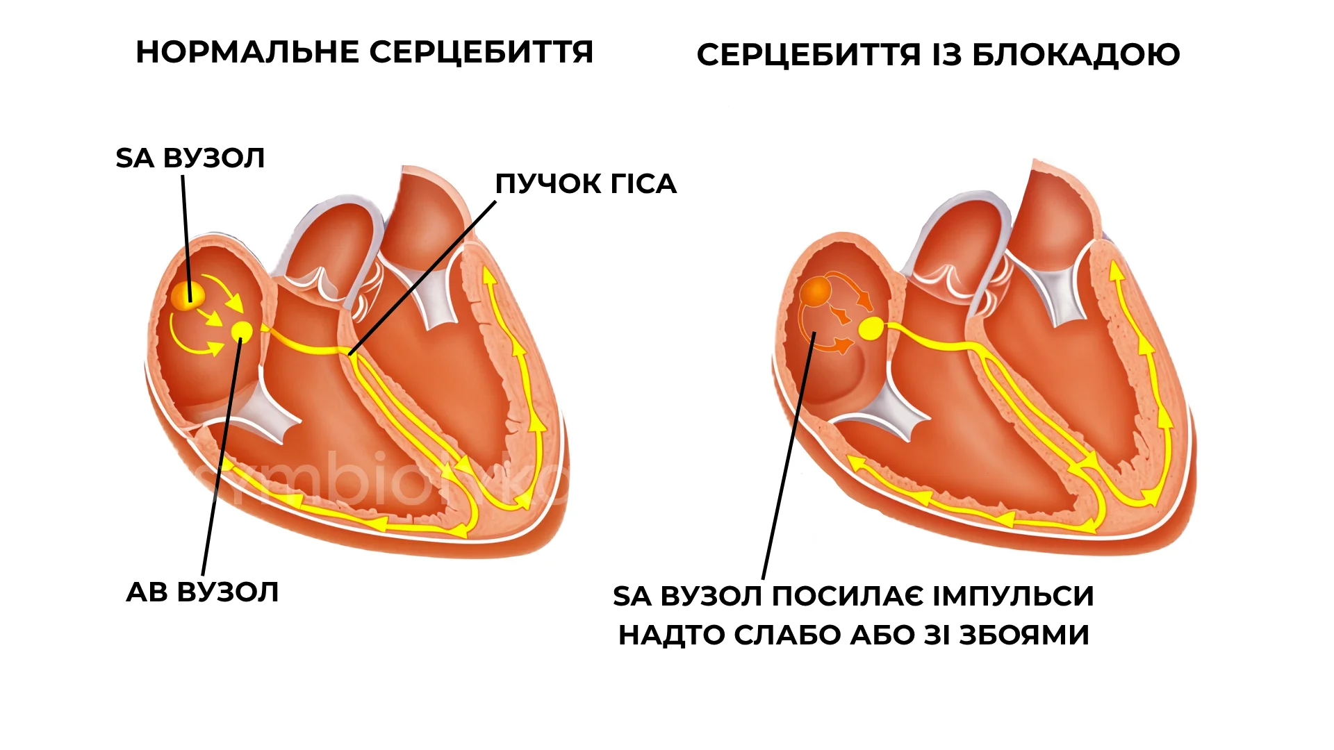 Синоатріальна блокада