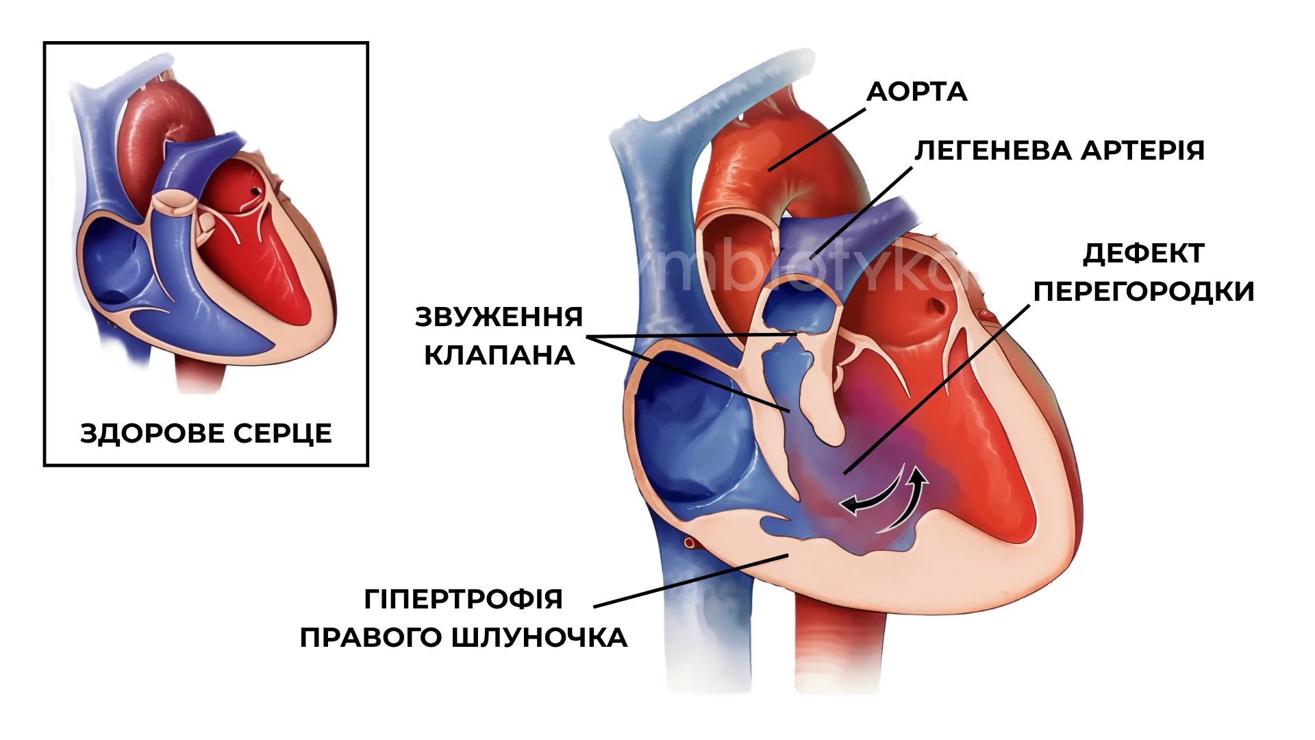 Тетрада Фалло