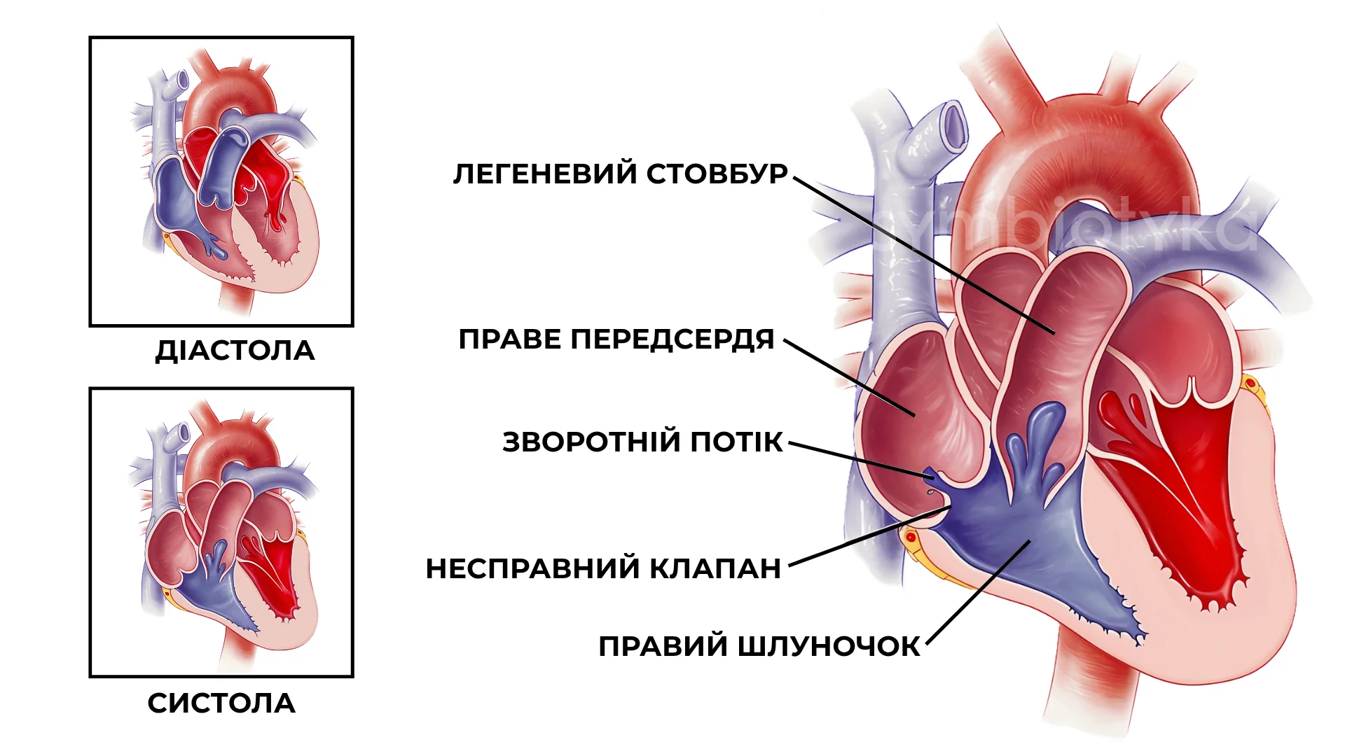 Трикуспідальна недостатність (регургітація)