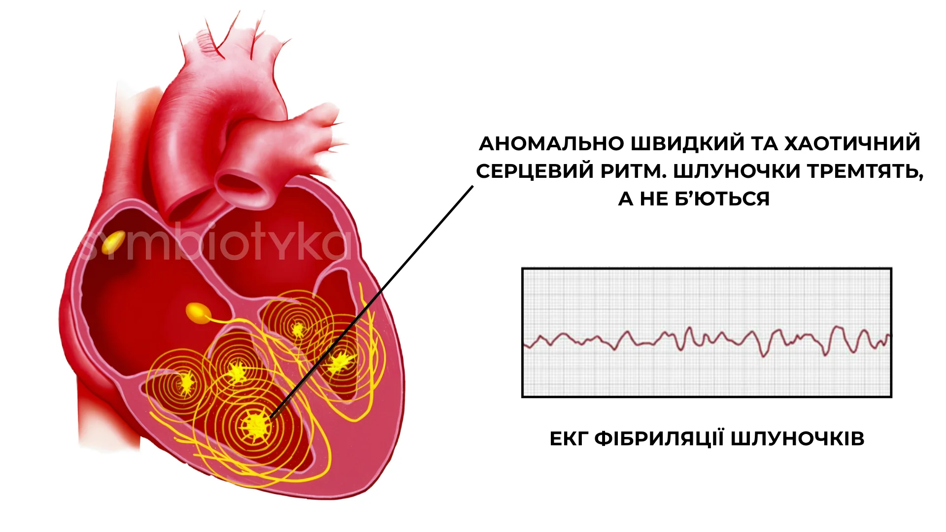 Фібриляція шлуночків (ФШ)