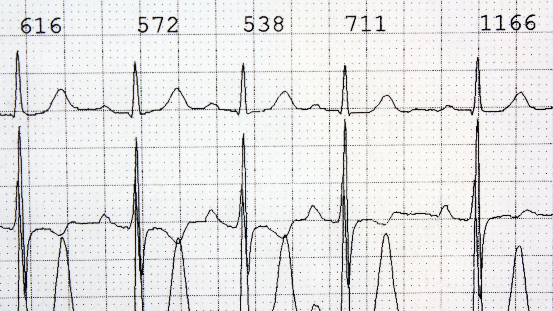 Тахікардія