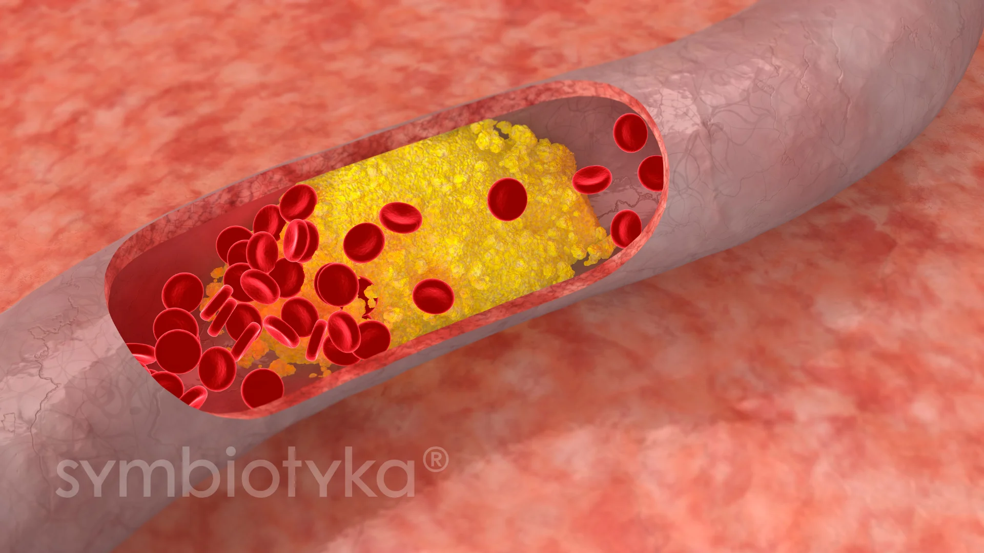 Атеросклеротичне ураження брахіоцефальних артерій