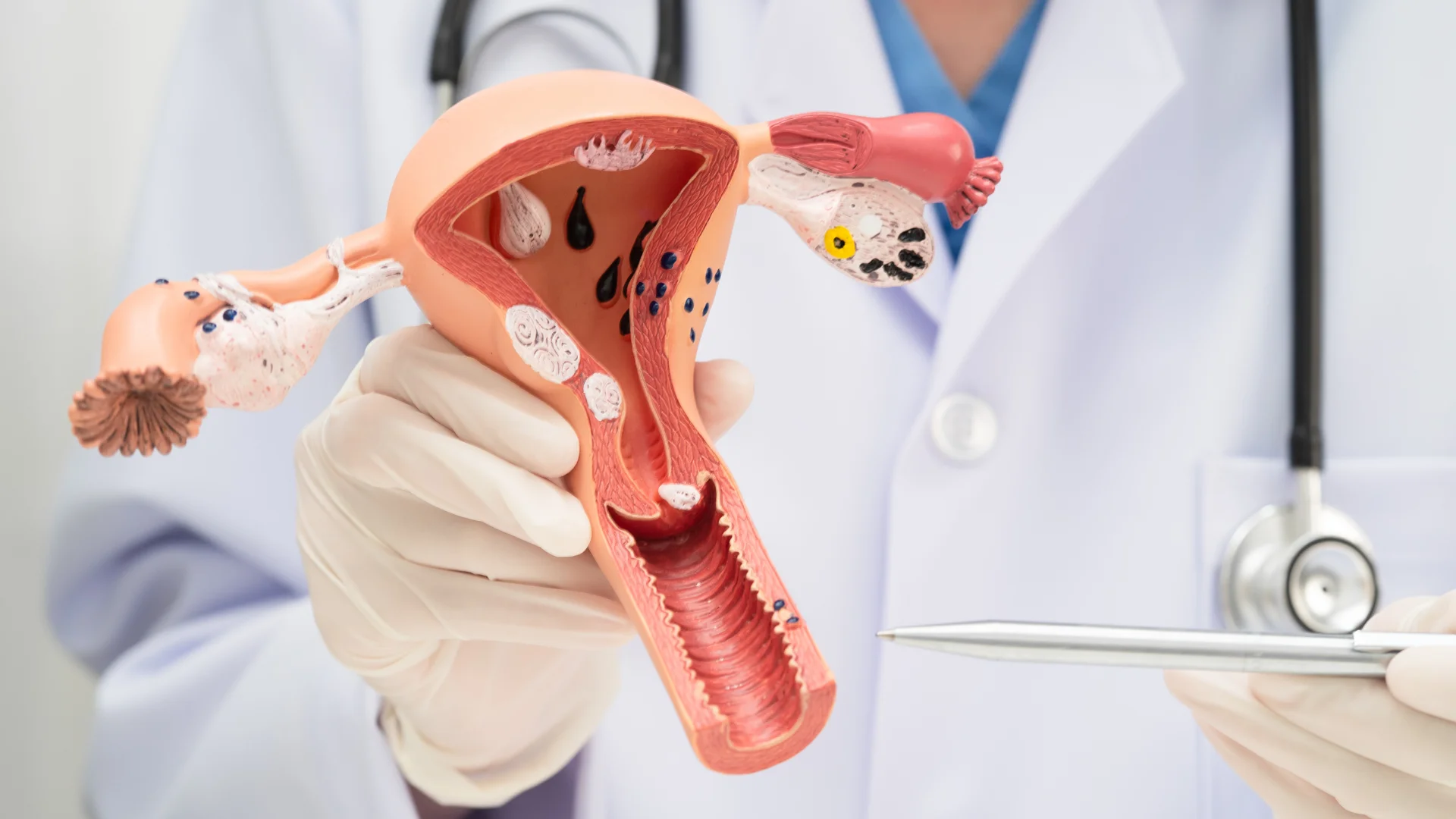 СПКЯ, ПМС, порушення циклу: коли до гінеколога, коли до ендокринолога