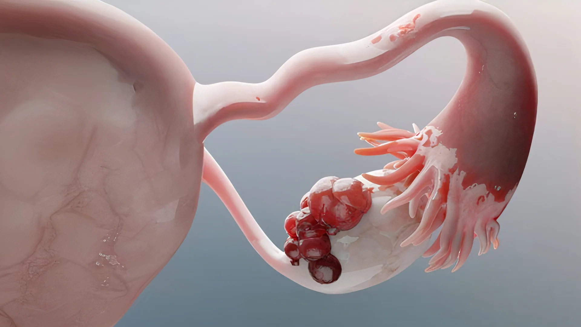 Ендометріоз: чому болючі місячні - це не норма