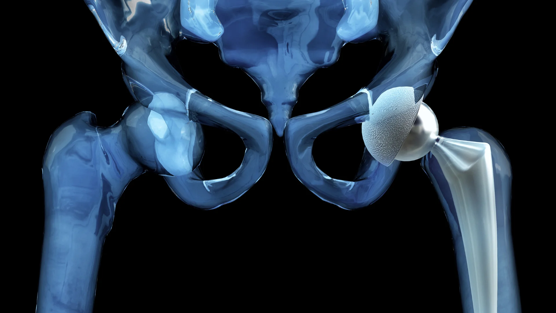 Скільки служить ендопротез і як продовжити його «життя