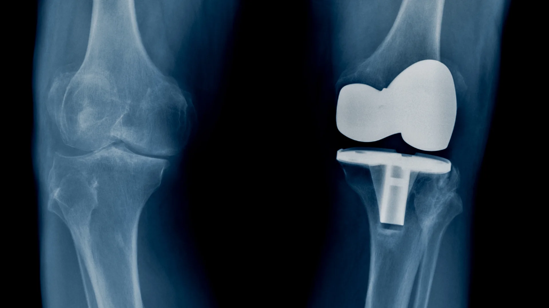 Підготовка до ендопротезування