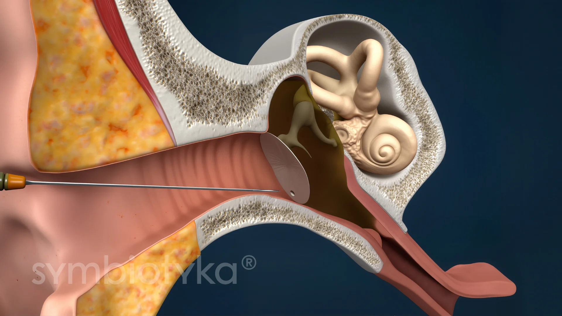 Парацентез