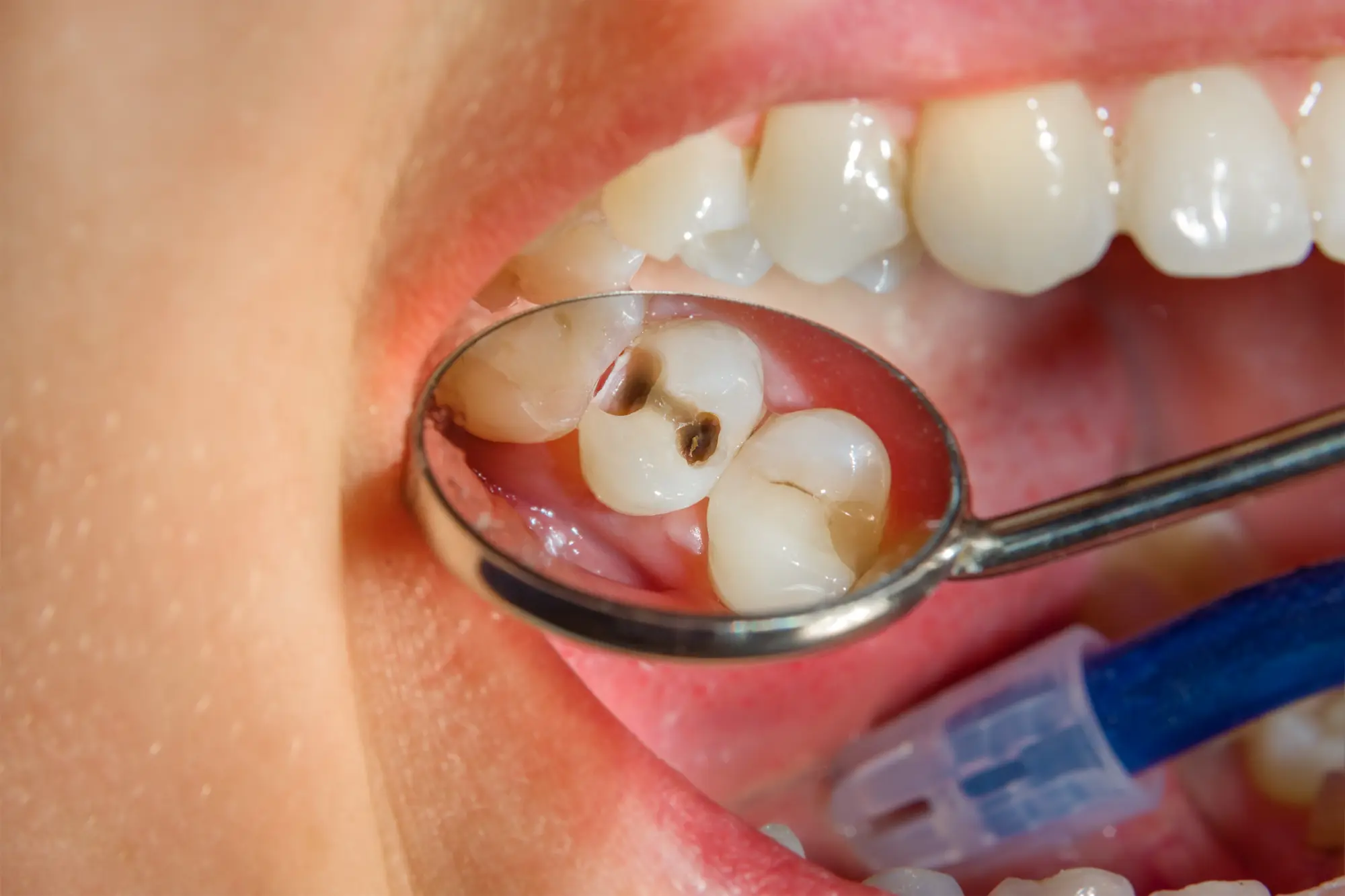 Curodont in Sacramento, CA | Express Dental Studio