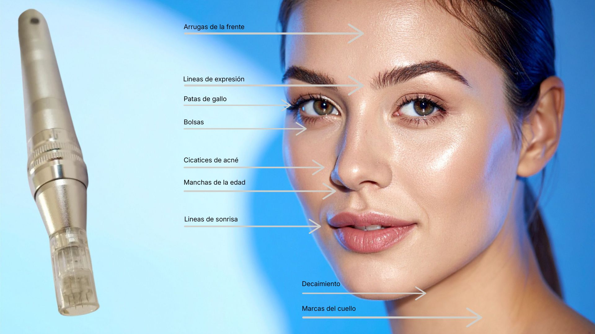 Zonas de aplicación del Dermapen facial para tratamiento de líneas finas y rejuvenecimiento en Logroño