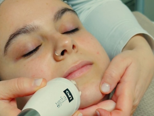 Sesión de LPG facial Logroño realizada por especialista en estética avanzada para reafirmación del rostro