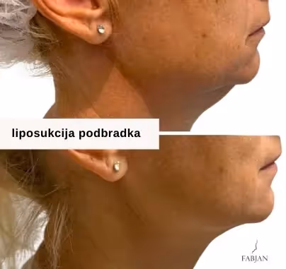 fotogafiji prej in po liposukciji podbradka pri ženski v srednjih letih.