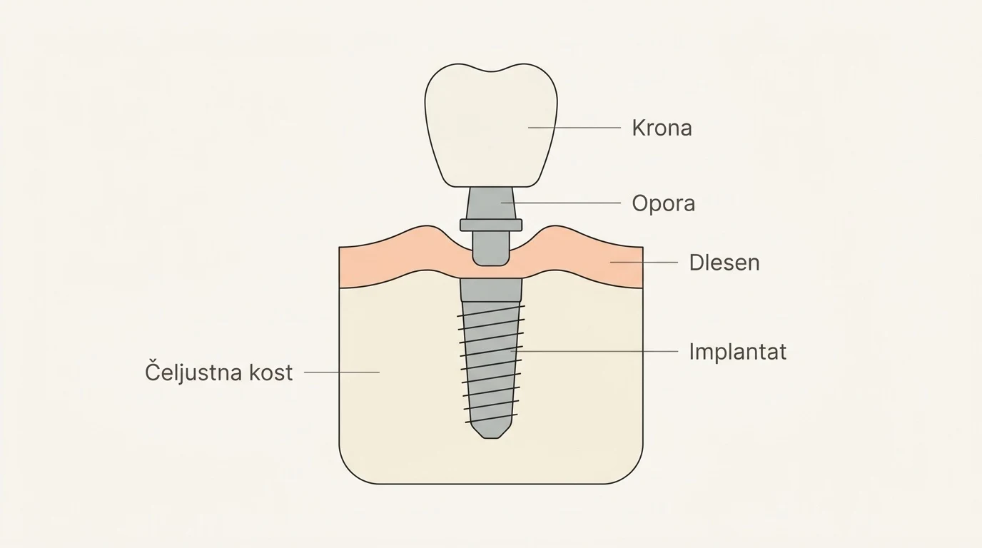 Shematski prikaz sestave zobnega implantata s krono, oporo in vijakom v čeljustni kosti.