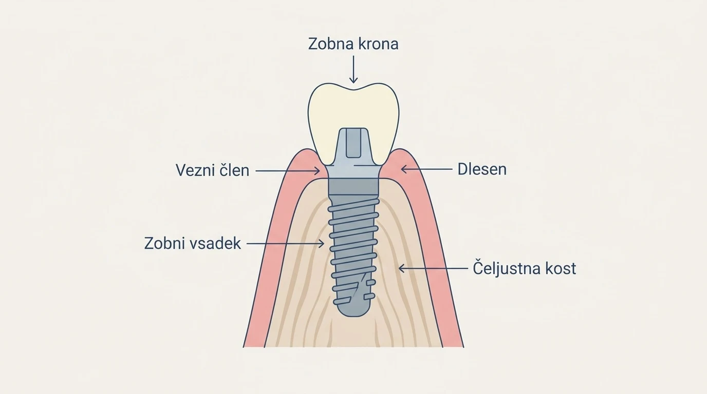 Shematski prikaz zobnega implantata v čeljustni kosti z označenimi deli: krona, vezni člen, vsadek, dlesen in kost.