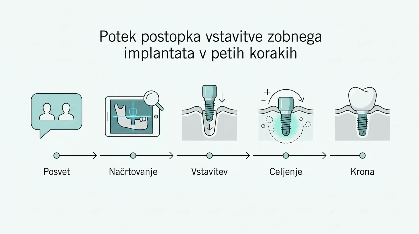 Shematski prikaz petih korakov do fiksnega zoba, od prvega posveta in načrtovanja do vstavitve in namestitve krone.