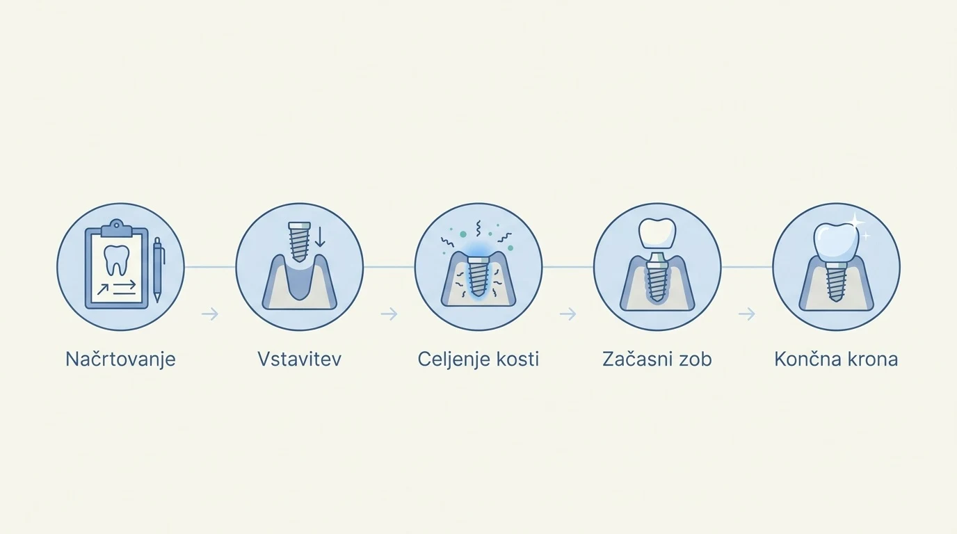 Shematski prikaz petih korakov postopka implantacije od načrtovanja do namestitve končne krone.