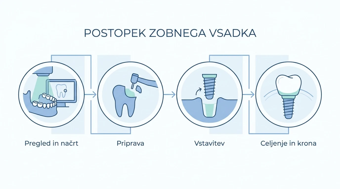 Shematski prikaz štirih korakov poti do zobnega implantata: pregled, priprava, vstavitev in končno celjenje.