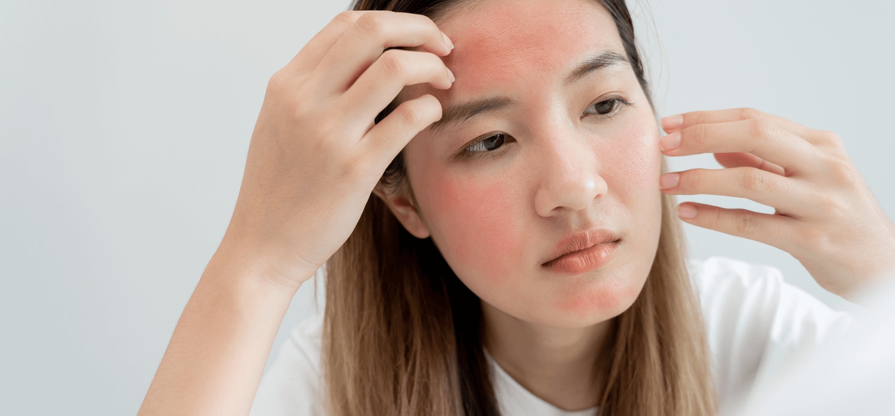 Young woman with facial redness and irritation caused by rosacea, considering treatment options from the best dermatologist in Bend.