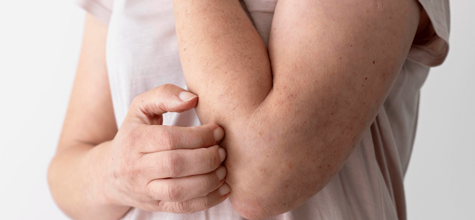 Person scratching their arm due to skin irritation, needs treatment at the best dermatology clinic in Bend for rashes, eczema, and other skin conditions.