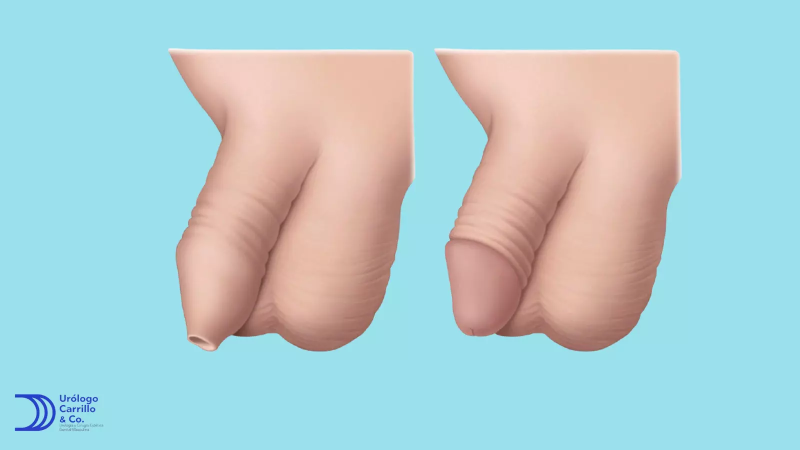 Fimosis vs prepucio que se retrae adecuadamente 