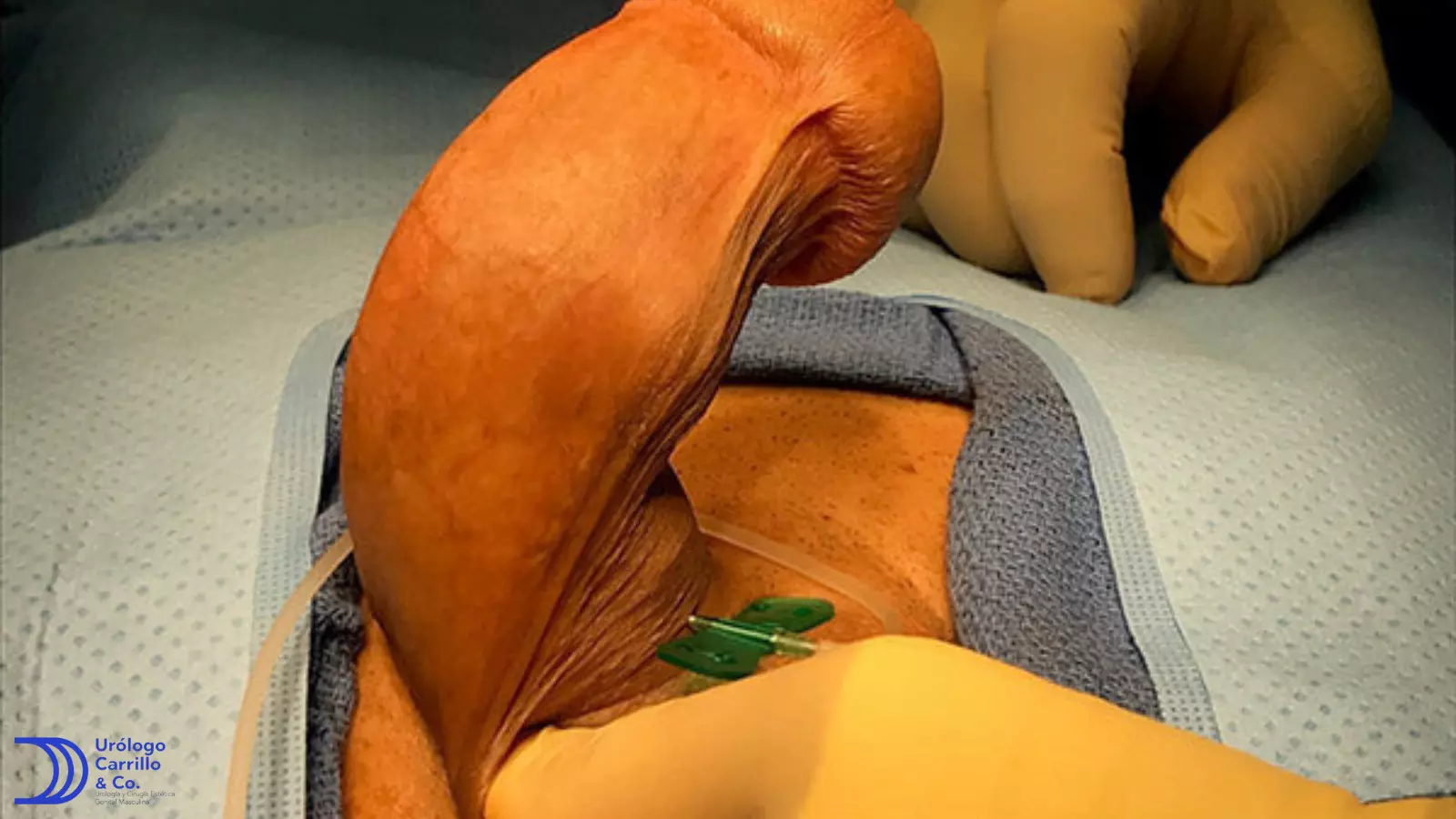 Foto de enfermedad de peyronie, curvatura marcada inferior izquierda