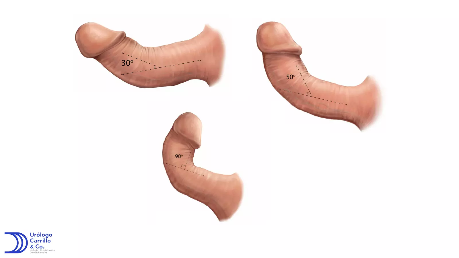 Foto distintos grados de enfermedad de peyronie 