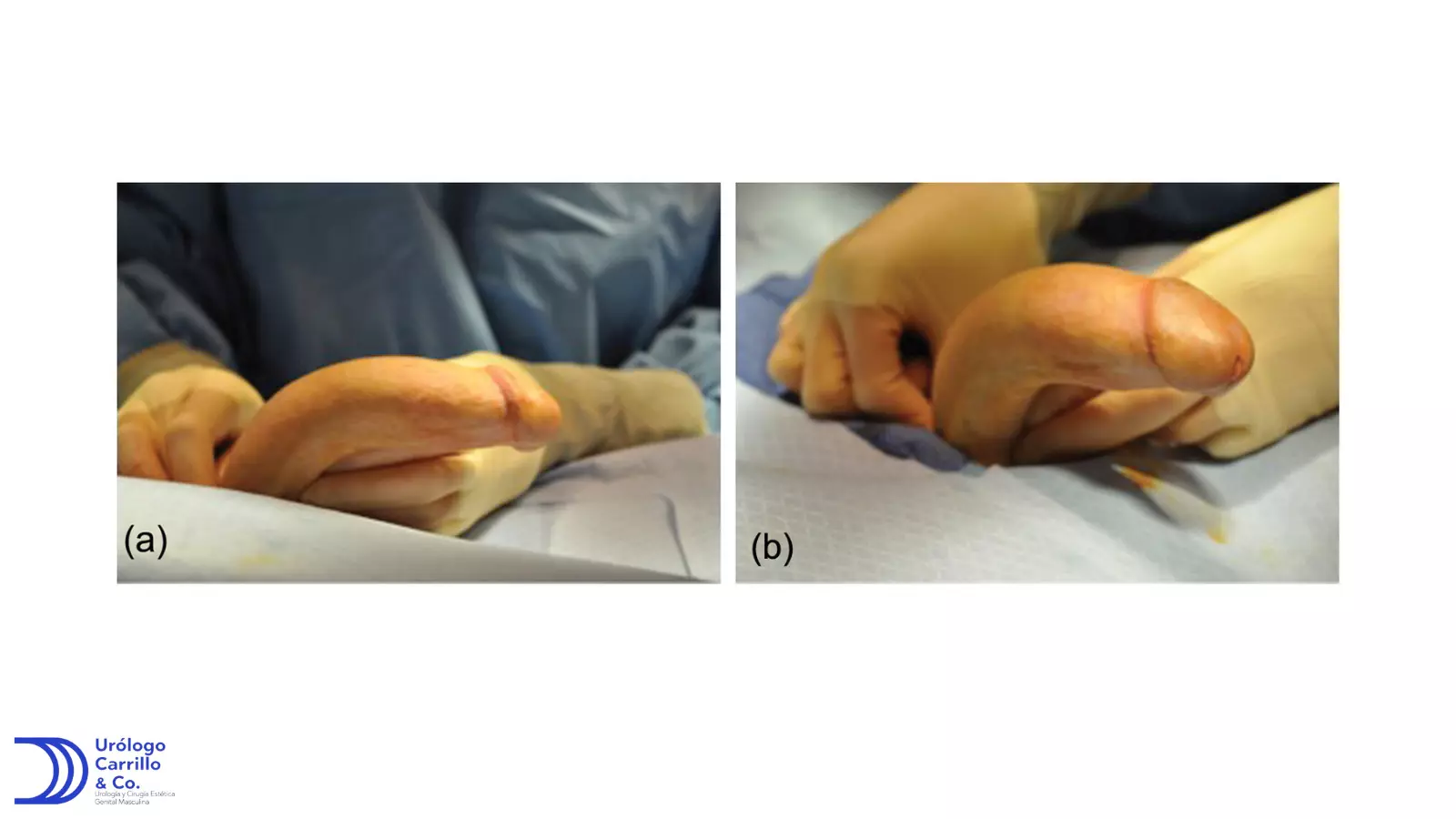 Foto de paciente con enfermedad de peyronie con pene con curvatura inferior derecha 