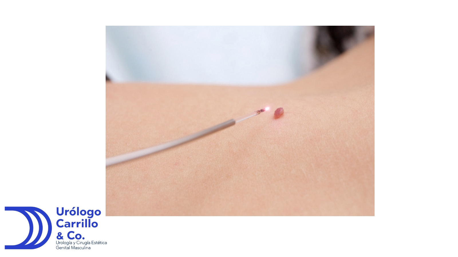 El laser es una herramienta muy potente para tratar lunares en el pene