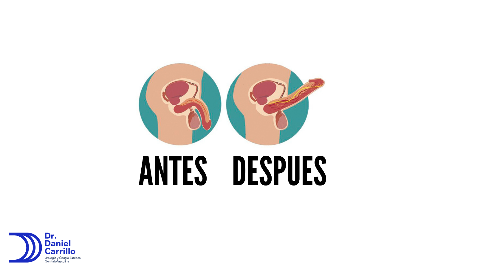 La imposibilidad de lograr o mantener una erección se conoce como disfunción eréctil 