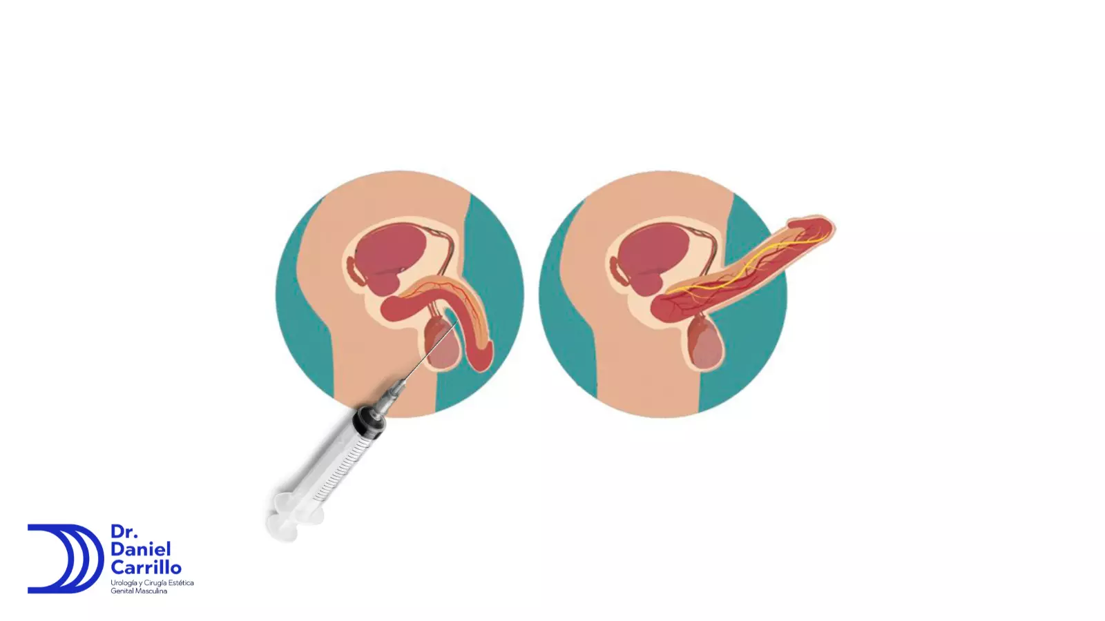 P-SHOT una herramienta mas para manejar las erecciones debiles 