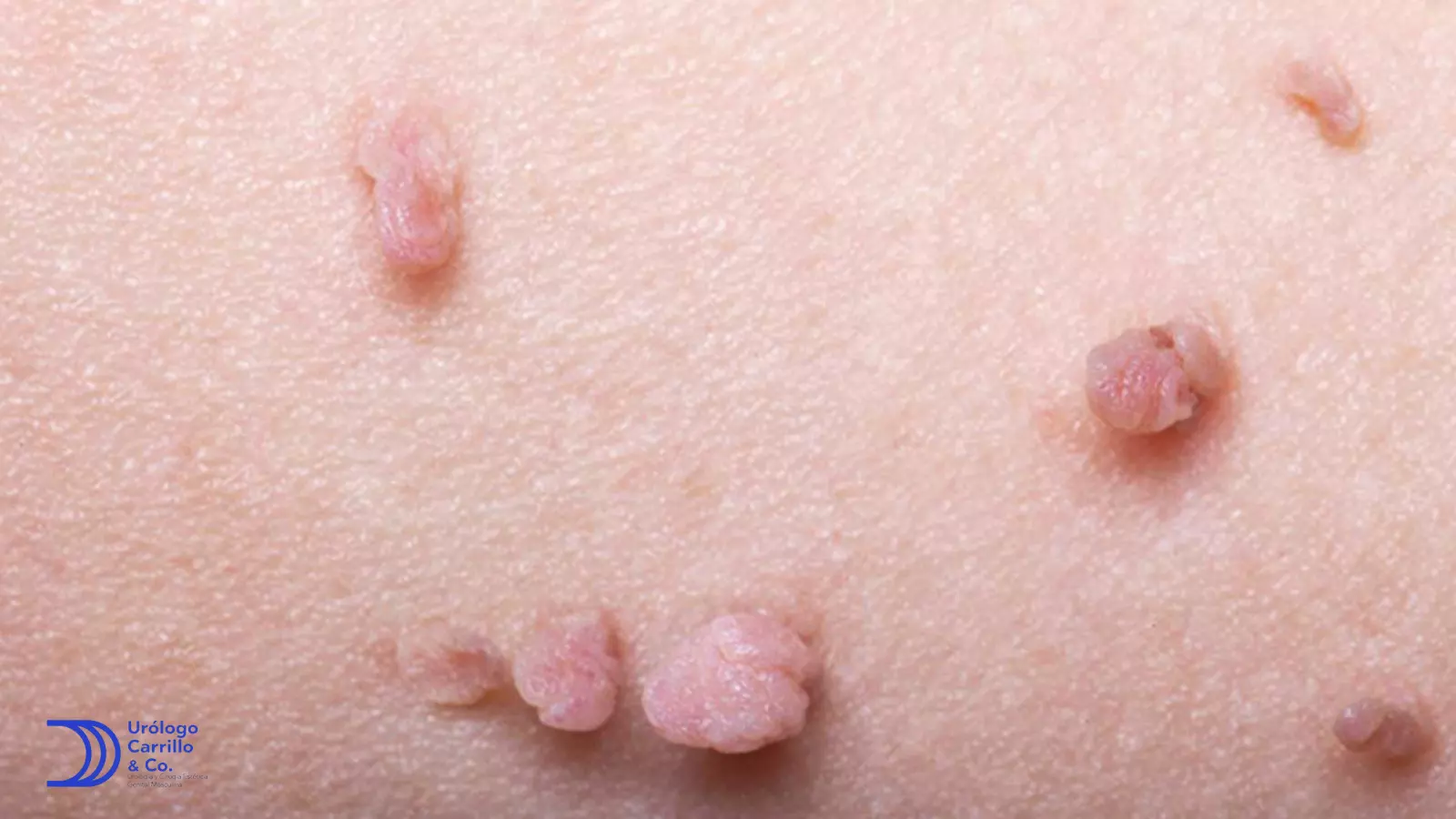 Verrugas genitales múltiples y voluminosas en un hombre 