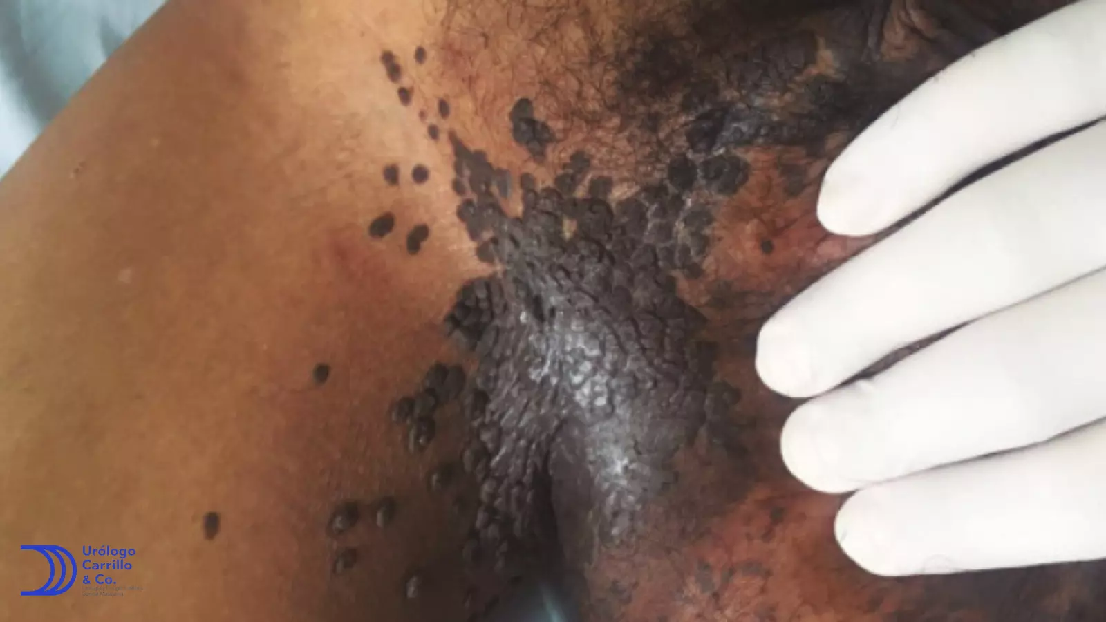 VPH en hombres, lesión precancerosa llamada papulomatosis bowenoide 