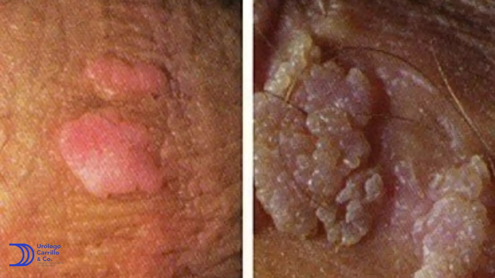VPH en hombres con apariencia de coliflores ( Condilomas acuminados)